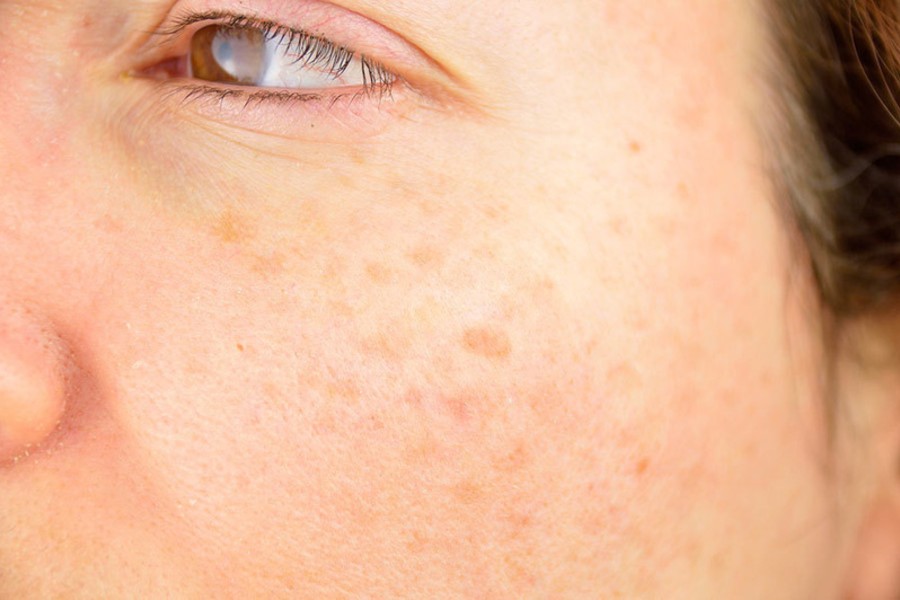 Nguyên nhân khiến da mặt bị tàn nhang là gì?Nguyên nhân khiến da mặt bị tàn nhang là gì?